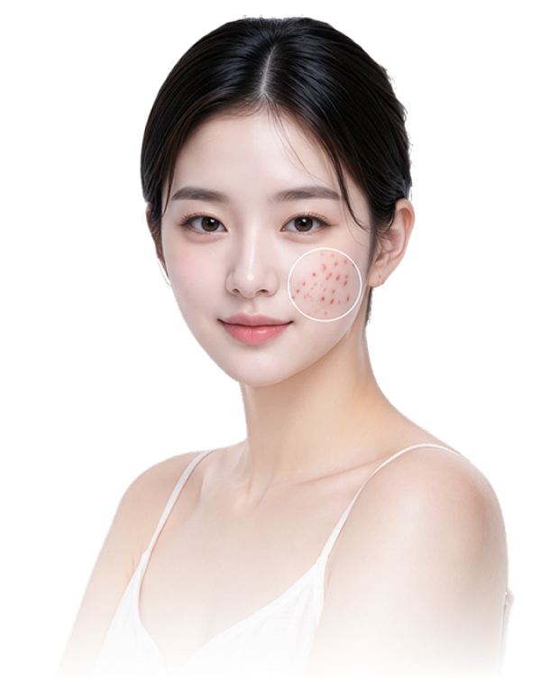 여드름